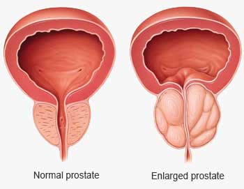 prostata hypertrophia jelentése