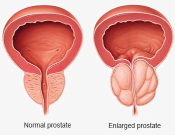 2. fokozatú prosztata adenoma mi ez