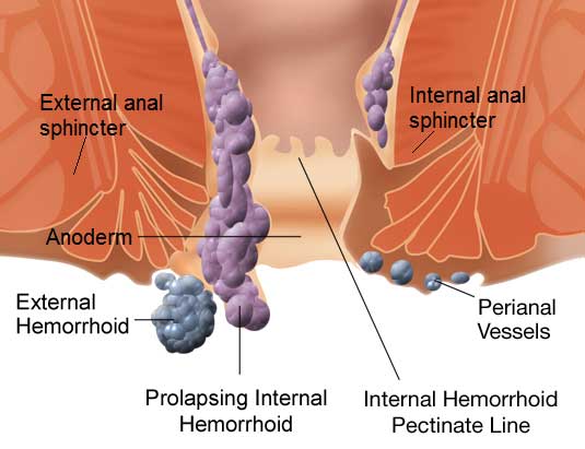 piles, haemhorroid